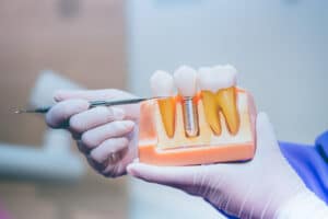 implant dentar inserare în os procedură stomatologică modernă