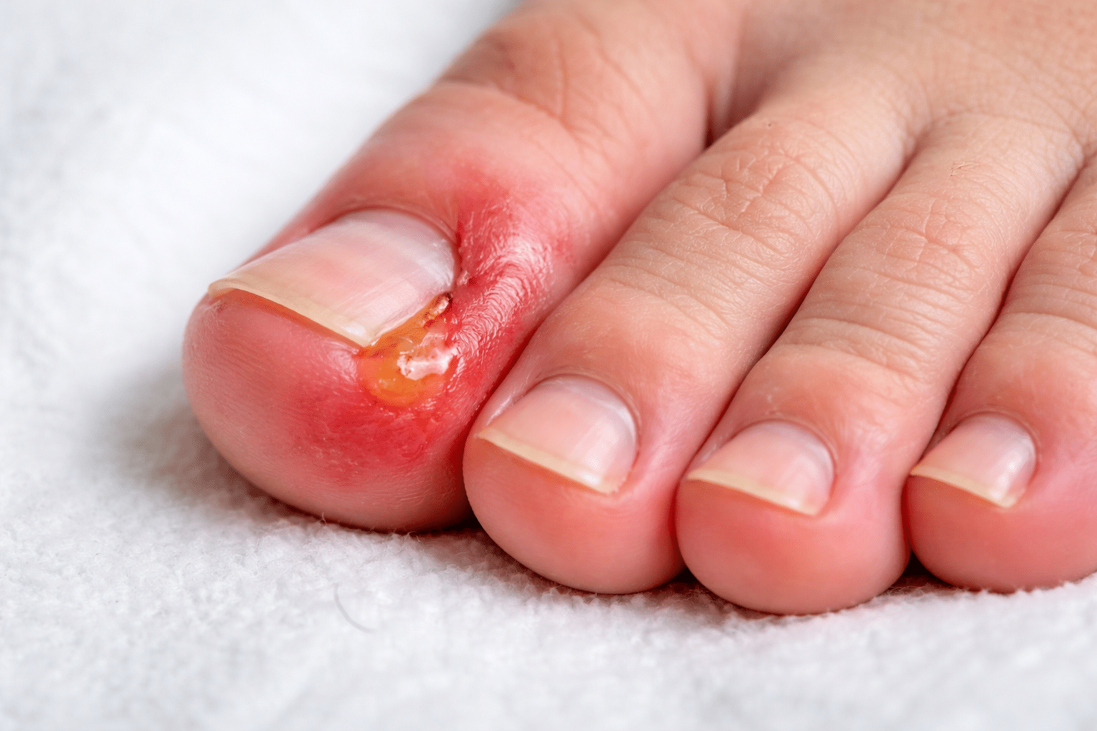 Tratament pentru unghie încarnată realizat corect de specialist