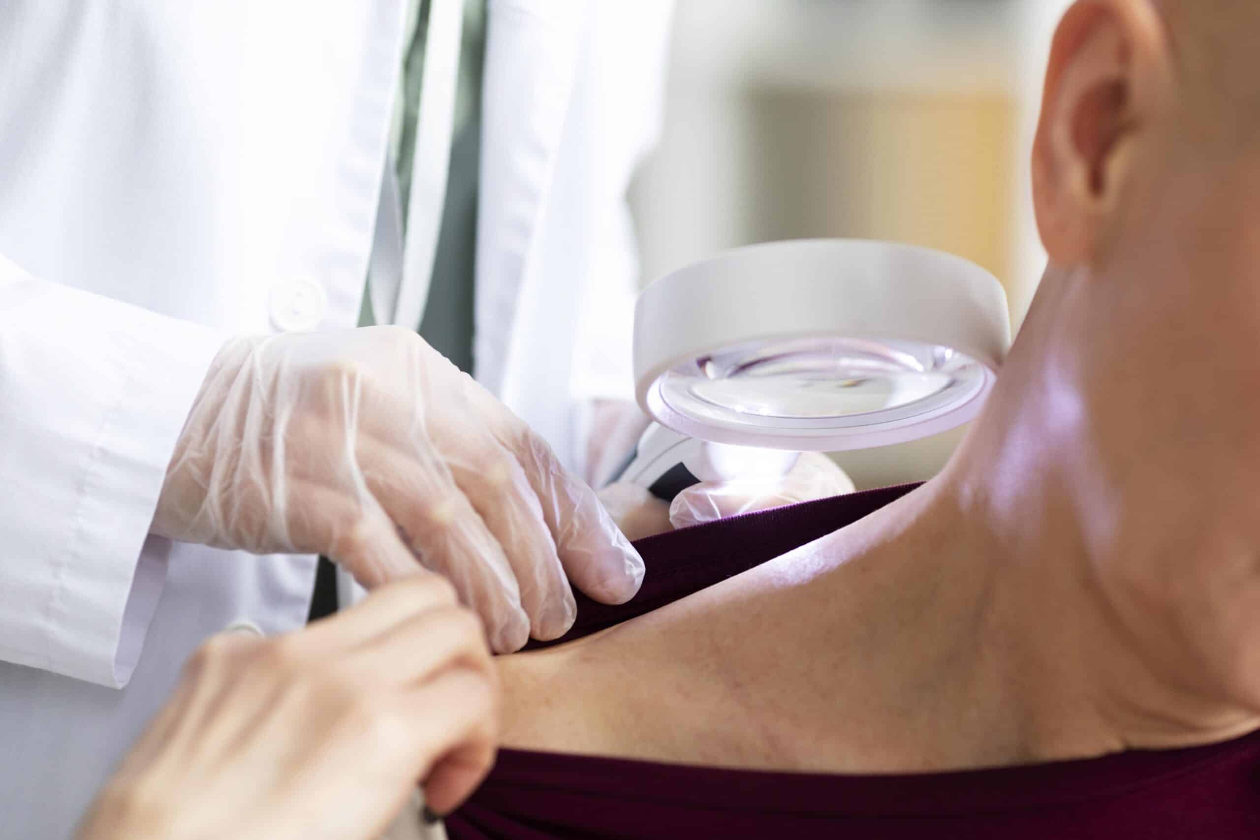 Medic dermatolog care examinează petele pigmentare de pe pielea unei paciente