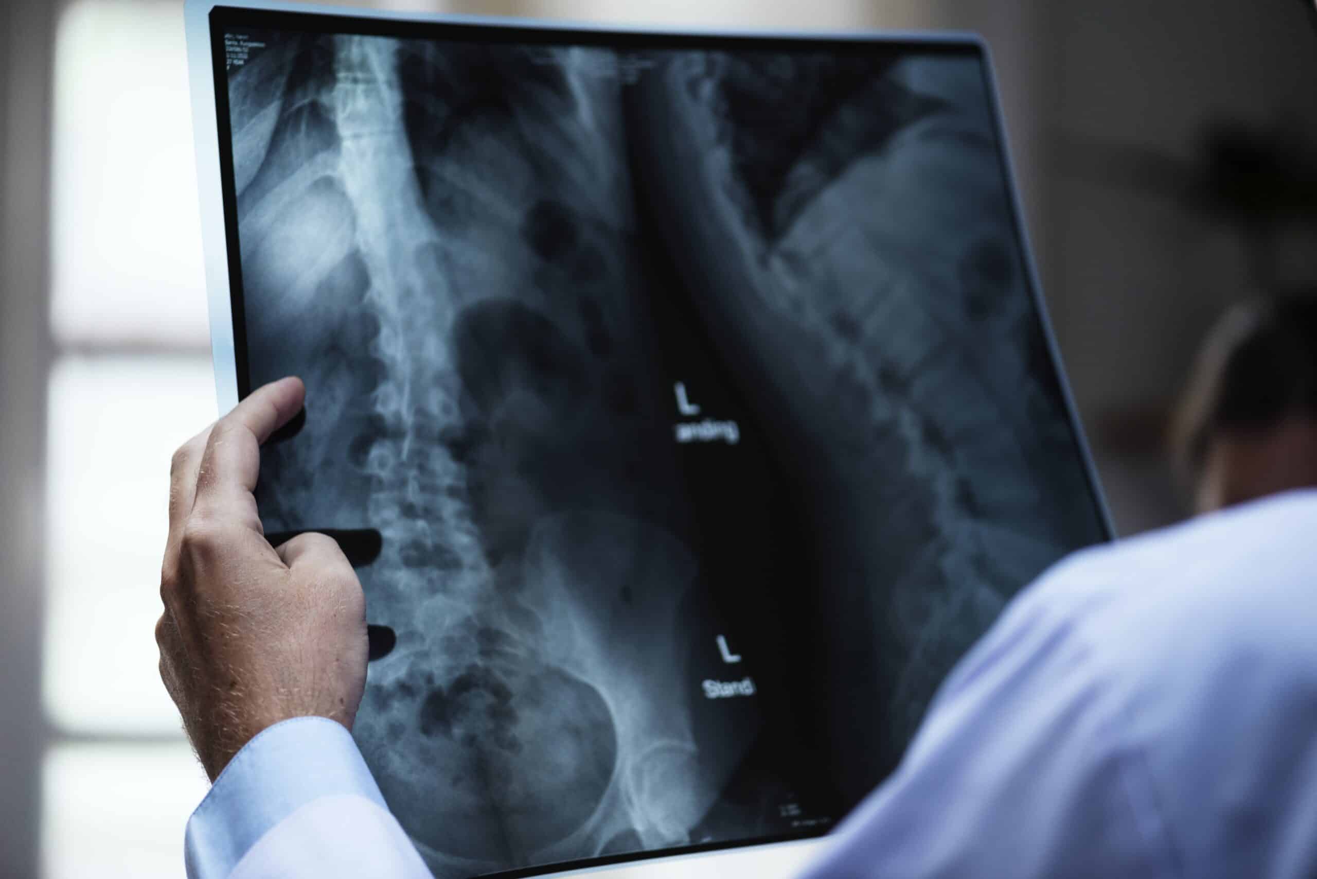 Imagine RMN de coloană utilizată pentru diagnosticarea herniei de disc