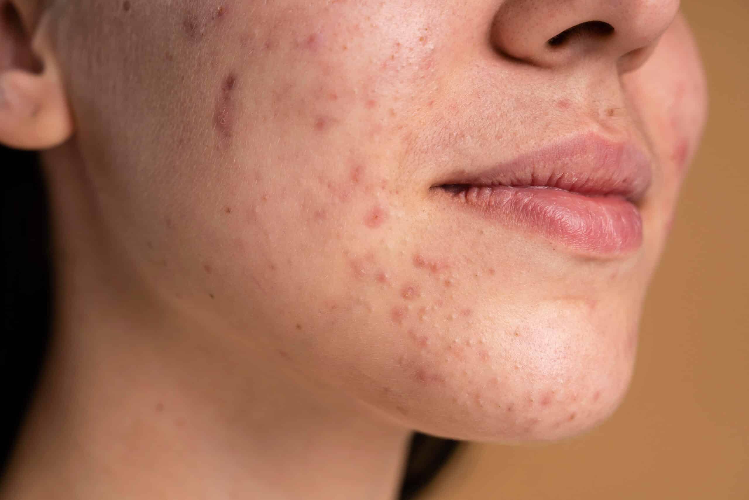 Acnee cauzata de dezechilibrul hormonal la femei